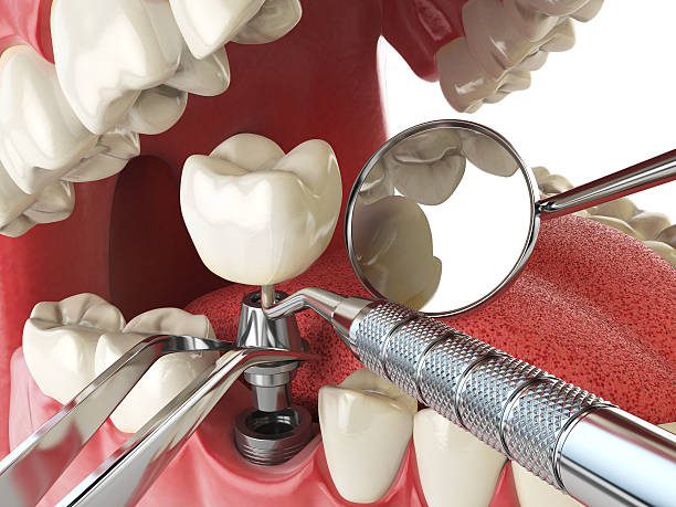 Best Emergency Root Canal Treatment in Graham, WA